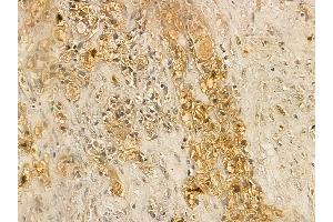 AWAT2 Mouse Monoclonal Antibody at 1/100 staining human kidney cancer by IHC-P. (AWAT2 抗体  (Internal Region))