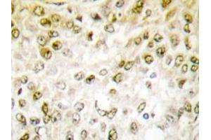 Immunohistochemistry analyzes of Chk1 antibody in paraffin-embedded human breast carcinoma tissue. (CHEK1 抗体)