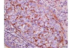 Formalin-fixed and paraffin embedded human lung carcinoma labeled with Rabbit Anti-pan-Cytokeratin Polyclonal Antibody, Unconjugated  at 1:200 followed by conjugation to the secondary antibody and DAB staining (Cytokeratin 1 抗体  (AA 101-200))