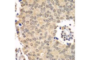 Immunohistochemistry of paraffin-embedded human prostate cancer using HDAC2 antibody. (HDAC2 抗体  (C-Term))