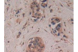 IHC-P analysis of Human Breast Cancer Tissue, with DAB staining. (GAP43 抗体  (AA 1-274))