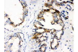 Anti- CTGF Picoband antibody, IHC(P) IHC(P): Human Mammary Cancer Tissue (CTGF 抗体  (AA 58-349))