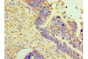 Immunohistochemistry of paraffin-embedded human ovarian cancer using ABIN7150514 at dilution of 1:100 (DNAJB2 抗体  (AA 2-324))