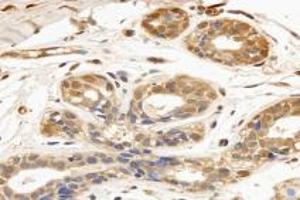 Immunohistochemistry analysis of paraffin-embedded human breast cancer using TPPP3 (ABIN7076047) at dilution of 1: 3000 (TPPP3 抗体)