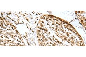 Immunohistochemistry of paraffin-embedded Human esophagus cancer tissue using H2AFJ Polyclonal Antibody at dilution of 1:170(x200) (H2AFJ 抗体)