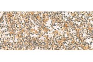 Immunohistochemistry of paraffin-embedded Human tonsil tissue using PPM1M Polyclonal Antibody at dilution of 1:100(x200) (PPM1M 抗体)
