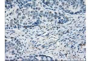 Immunohistochemical staining of paraffin-embedded Adenocarcinoma of colon tissue using anti-LTA4H mouse monoclonal antibody. (LTA4H 抗体)