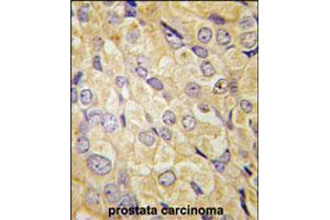 Formalin-fixed and paraffin-embedded human prostate carcinoma tissue reacted with FZD1 polyclonal antibody  , which was peroxidase-conjugated to the secondary antibody, followed by DAB staining. (FZD1 抗体  (Internal Region))