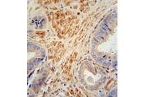 Immunohistochemistry analysis in formalin fixed and paraffin embedded human prostate carcinoma reacted with FSTL1 Antibody (C-term) followed by peroxidase conjugation of the secondary antibody and DAB staining. (FSTL1 抗体  (C-Term))