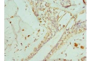 Immunohistochemistry of paraffin-embedded human breast cancer using ABIN7151371 at dilution of 1:100 (ENTPD2 抗体  (AA 28-268))