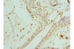 Immunohistochemistry of paraffin-embedded human breast cancer using ABIN7151371 at dilution of 1:100 (ENTPD2 抗体  (AA 28-268))