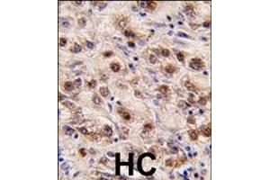 Formalin-fixed and paraffin-embedded human hepatocarcinoma tissue reacted with MINA (C-term) (ABIN387880 and ABIN2844089) , which was peroxidase-conjugated to the secondary antibody, followed by DAB staining. (MINA 抗体  (C-Term))