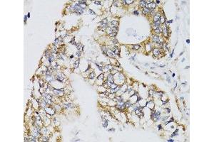 Immunohistochemistry of paraffin-embedded Human gastric cancer using CHN1 Polyclonal Antibody at dilution of 1:100 (40x lens). (CHN1 抗体)
