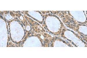 Immunohistochemistry of paraffin-embedded Human thyroid cancer tissue using CNTN4 Polyclonal Antibody at dilution of 1:65(x200) (Contactin 4 抗体)