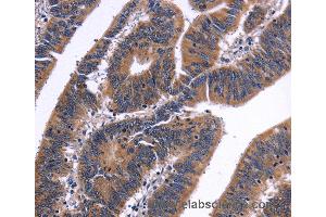 Immunohistochemistry of Human liver cancer using NFATC3 Polyclonal Antibody at dilution of 1:50 (NFATC3 抗体)