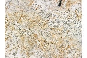 ABIN6263601 and ABIN6276613 at 1/100 staining human gastric carcinoma by IHC-P. (NET1 抗体  (C-Term))