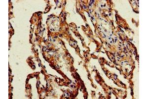 Immunohistochemistry of paraffin-embedded human lung cancer using ABIN7154472 at dilution of 1:100 (GADD45G 抗体  (AA 1-159))