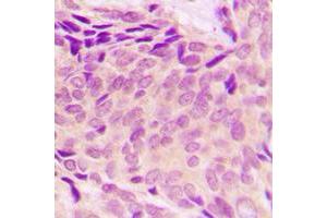 Immunohistochemical analysis of RPL37A staining in human breast cancer formalin fixed paraffin embedded tissue section. (RPL37A 抗体  (Center))