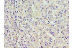 Immunohistochemistry of paraffin-embedded human liver cancer using ABIN7142321 at dilution of 1:100 (ACAA1 抗体  (AA 27-300))