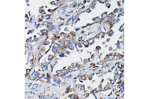 Immunohistochemistry of paraffin-embedded human lung cancer using GSTK1 Rabbit pAb (ABIN1680136, ABIN3019398, ABIN3019399 and ABIN6220875) at dilution of 1:25 (40x lens). (GSTK1 抗体  (AA 1-226))