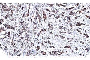 IHC-P Image Immunohistochemical analysis of paraffin-embedded human breast cancer, using MAP2K2, antibody at 1:100 dilution. (MEK2 抗体)