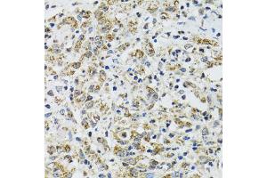 Immunohistochemistry of paraffin-embedded human uterine cancer using TXN2 antibody (ABIN2560616) at dilution of 1:100 (40x lens). (TXN2 抗体)