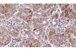 ABIN6272365 at 1/100 staining Human liver cancer tissue by IHC-P. (NMUR1 抗体  (N-Term))