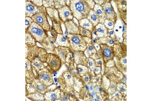 Immunohistochemistry of paraffin-embedded human liver injury using ASGR1 antibody (ABIN5975060) at dilution of 1/100 (40x lens).