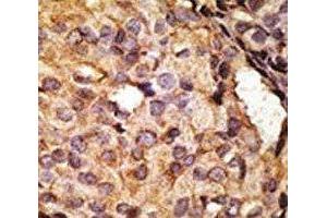 IHC analysis of FFPE human breast carcinoma tissue stained with the TLR6 antibody (TLR6 抗体  (AA 722-753))