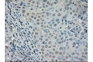 Immunohistochemical staining of paraffin-embedded Adenocarcinoma of ovary tissue using anti-DHFRmouse monoclonal antibody. (Dihydrofolate Reductase 抗体)