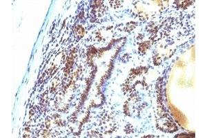 Formalin-fixed, paraffin-embedded human thyroid carcinoma stained with MAP3K1 antibody (2F6). (MAP3K1 抗体  (AA 1211-1310))