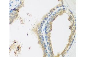Immunohistochemistry of paraffin-embedded Human prostate using WDR77 Polyclonal Antibody at dilution of 1:200 (40x lens). (WDR77 抗体)