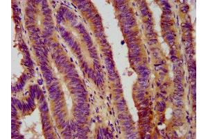 IHC image of ABIN7152698 diluted at 1:800 and staining in paraffin-embedded human colon cancer performed on a Leica BondTM system. (FERMT1 抗体  (AA 321-420))