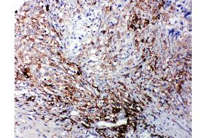 Anti-LTBR antibody, IHC(P) IHC(P): Human Intestinal Cancer Tissue (LTBR 抗体  (C-Term))