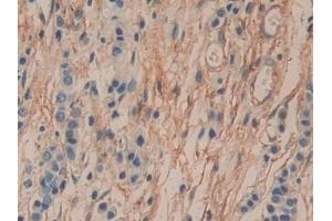 Detection of CD90 in Human Stomach cancer Tissue using Polyclonal Antibody to Cluster of Differentiation 90 (CD90)