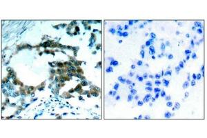 Immunohistochemical analysis of paraffin-embedded human lung carcinoma tissue using PKCth(Phospho-Ser695) Antibody(left) or the same antibody preincubated with blocking peptide(right). (PKC theta 抗体  (pSer695))