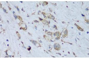 Immunohistochemistry of paraffin-embedded Human gastric cancer using ENPP3 Polyclonal Antibody at dilution of 1:150 (40x lens). (ENPP3 抗体)