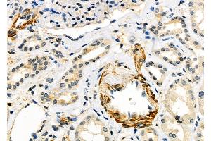 ABIN6259876 and ABIN6279101 at 1/100 staining Human kidney cancer and adjacent normal tissues by IHC-P. (ALDH1A3 抗体  (Internal Region))