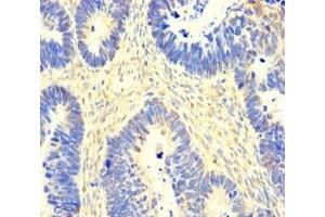 Immunohistochemistry of paraffin-embedded human ovarian cancer using ABIN7163155 at dilution of 1:100 (SACM1L 抗体  (AA 301-520))