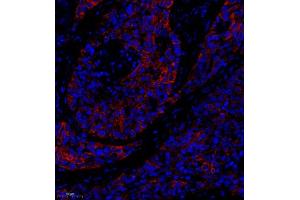 Immunofluorescence of paraffin embedded human lung cancer using MRP1 (ABIN7074544) at dilution of 1:1000 (250x lens) (MRP1 抗体)