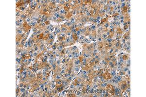 Immunohistochemistry of Human liver cancer using BCL10 Polyclonal Antibody at dilution of 1:40 (BCL10 抗体)