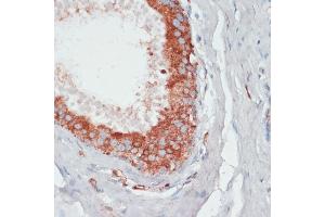 Immunohistochemistry of paraffin-embedded human mammary cancer using PGK2 antibody (ABIN6128431, ABIN6145506, ABIN6145507 and ABIN6216775) at dilution of 1:100 (40x lens). (PGK2 抗体  (AA 242-360))