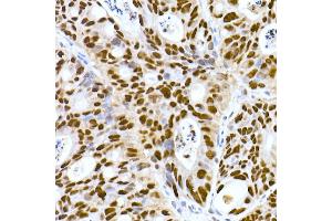 Immunohistochemistry of paraffin-embedded human colon carcinoma using DNA-PKcs Rabbit mAb (ABIN7269665) at dilution of 1:100 (40x lens). (PRKDC 抗体)