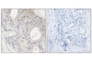 Immunohistochemistry analysis of paraffin-embedded human breast carcinoma tissue, using Cytochrome P450 1A2 antibody. (CYP1A2 抗体  (Internal Region))