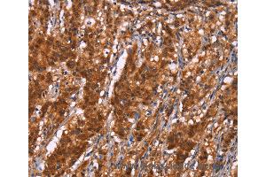 Immunohistochemistry of Human gastric cancer using BRK1 Polyclonal Antibody at dilution of 1:40 (BRK1 抗体)