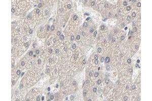 ABIN6267630 at 1/200 staining human liver cancer tissue sections by IHC-P. (Acetyl-CoA Carboxylase alpha 抗体  (pSer79))