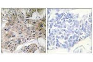 Immunohistochemistry analysis of paraffin-embedded human breast carcinoma tissue using COX7S/A2 antibody. (COX7A2P2 抗体)