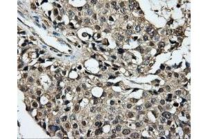 Immunohistochemical staining of paraffin-embedded Adenocarcinoma of breast tissue using anti-PLEK mouse monoclonal antibody. (Pleckstrin 抗体)