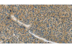 Immunohistochemistry of paraffin-embedded Human liver cancer tissue using Connexin-45 Polyclonal Antibody at dilution 1:50 (GJC1 抗体)