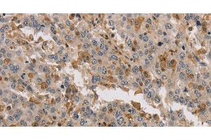 Immunohistochemistry of paraffin-embedded Human liver cancer tissue using KIF17 Polyclonal Antibody at dilution 1:40 (KIF17 抗体)
